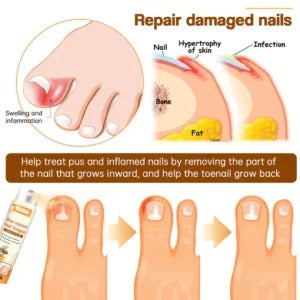 Nail Treatment Spray Bee Venom